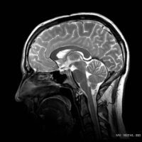 Image of a human head using MRI
